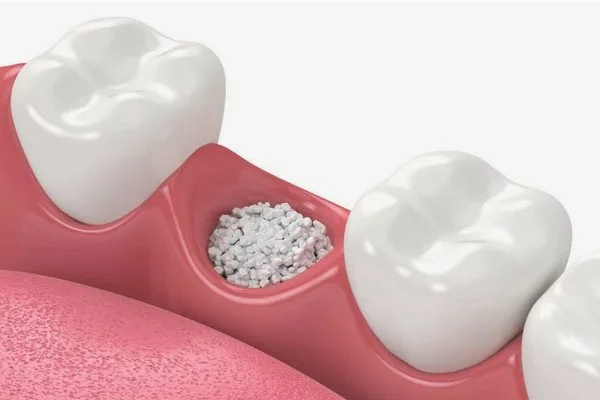 Dental Bone Grafting