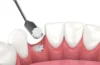 Dental Bone Grafting