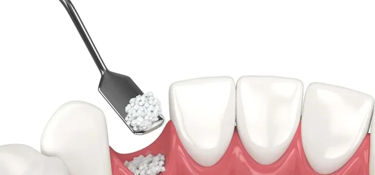 Dental Bone Grafting