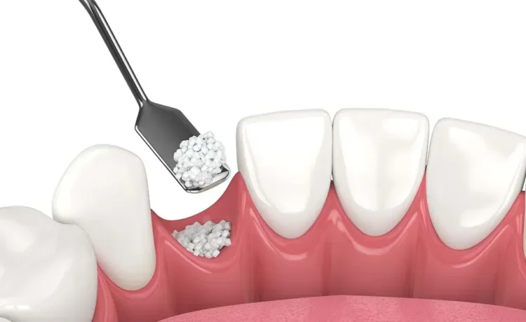 Dental Bone Grafting