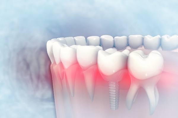 Dental Implants