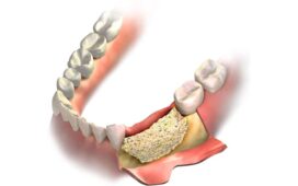 Bone Regenerations