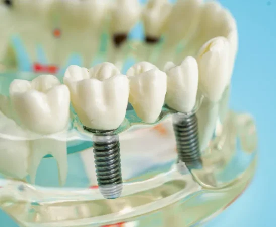 Dental Implants