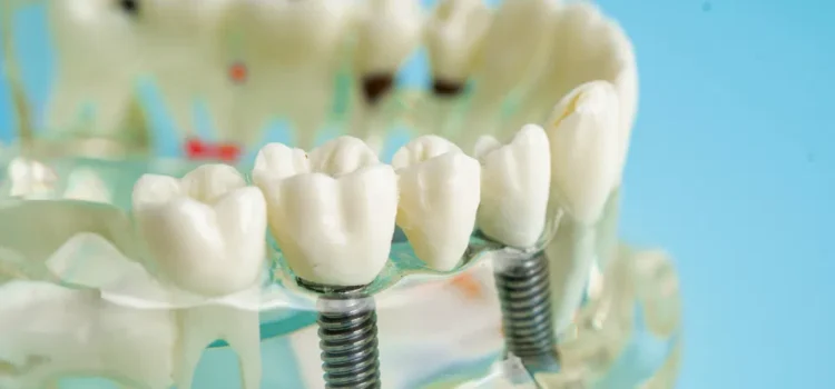 Dental Implants