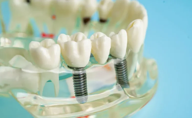 Dental Implants